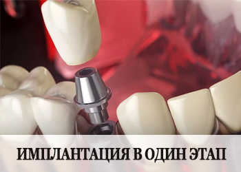 Одноэтапный метод имплантации