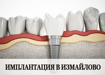 Проведение имплантации зубов Имплантация зубов